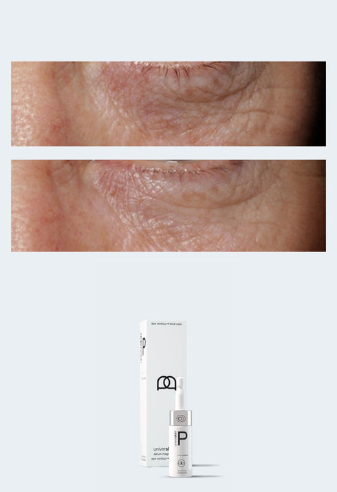 Personalised Skincare Medical Grade Under-eye Pigmentation, Wrinkles & Fine Lines Eye Serum Treatment