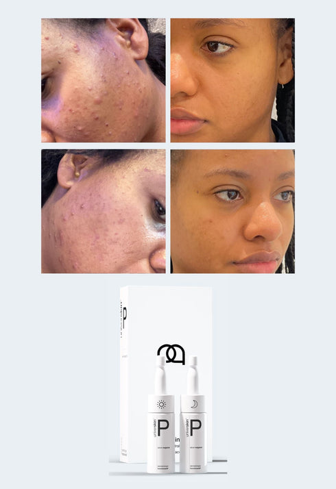 Personalised Skincare Medical Grade Acne Skincare Treatment