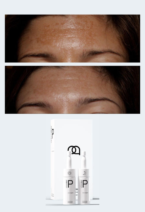 Personalised Skincare Medical Grade Melasma Skincare Treatment