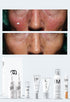 Personalised Medical Grade Prescription Skincare Treatment for Rosacea complete package
