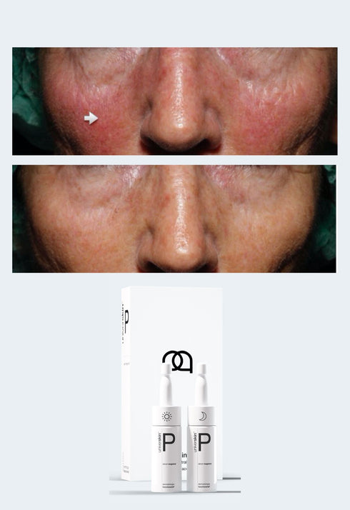 Personalised Skincare Medical Grade Rosacea Skincare Treatment