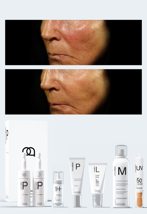 Personalised Medical Grade Prescription Skincare Treatment for Skin Redness complete package