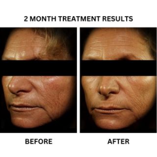 Before and after photographs from the existing "Radiance Boost" - A Personalised Skincare Package of Medical Grade Skincare for Radiant & Glowing Skin banner.